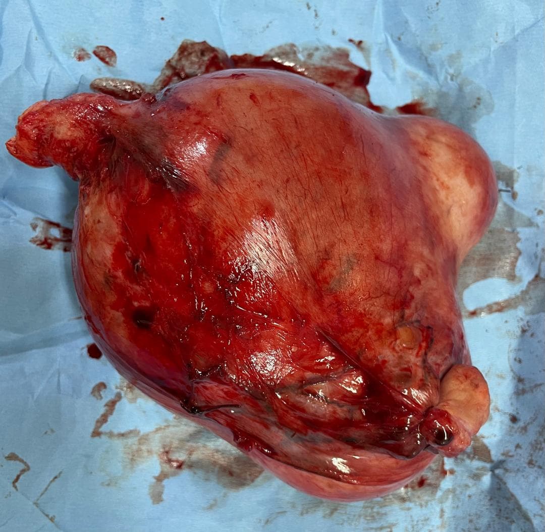 Uterus with adenomyosis