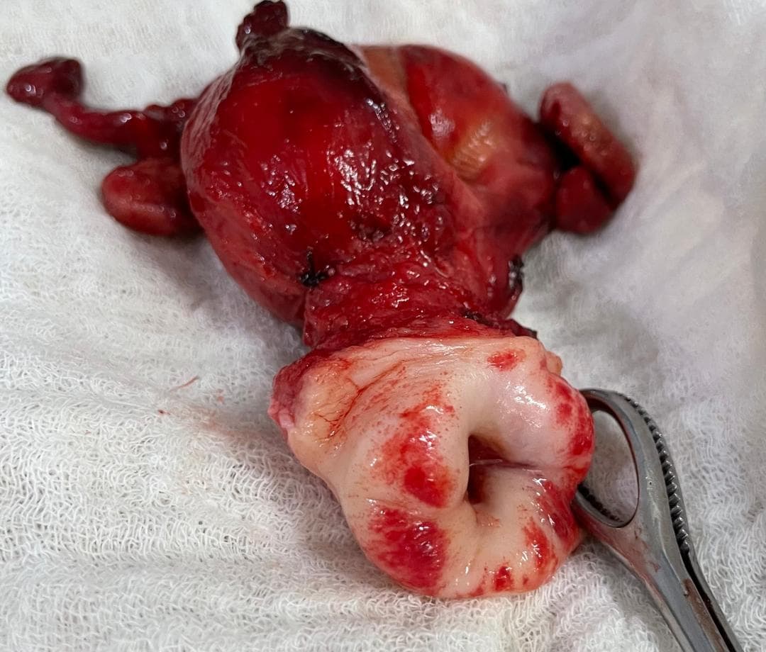Severe cervical dysplasia