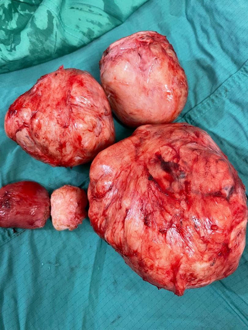 Fibroid removal