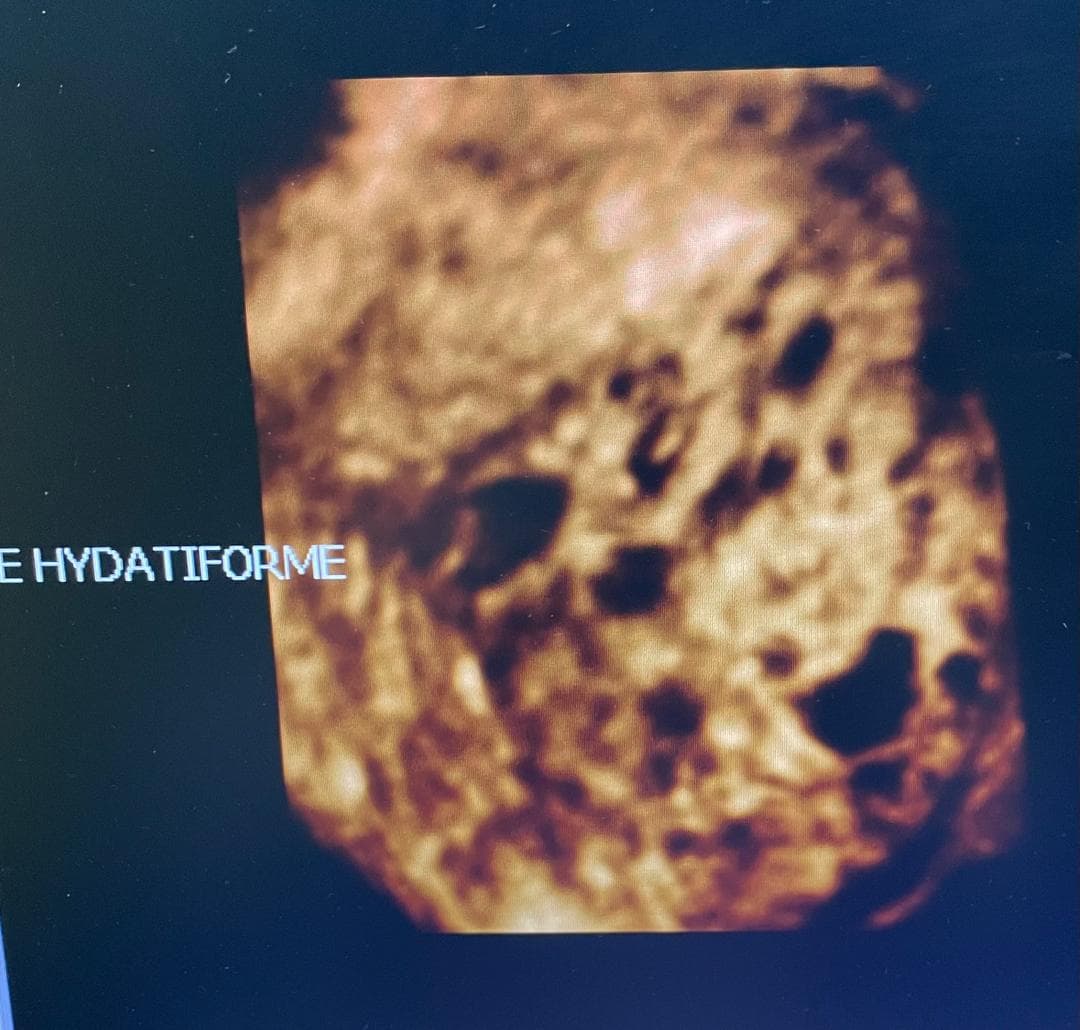 Molar pregnancy