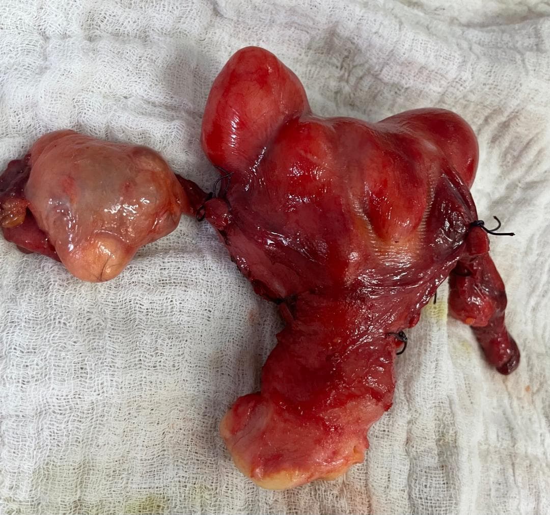 Ovarian mass with fibroids
