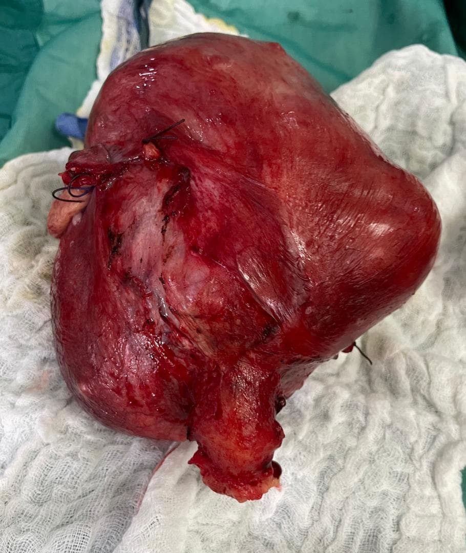Polyfibroid uterus